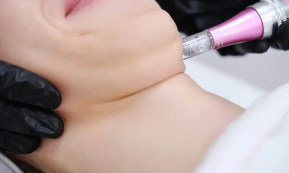 Mini Reducción de Mentón - Reducción focal para perfilar el mentón.